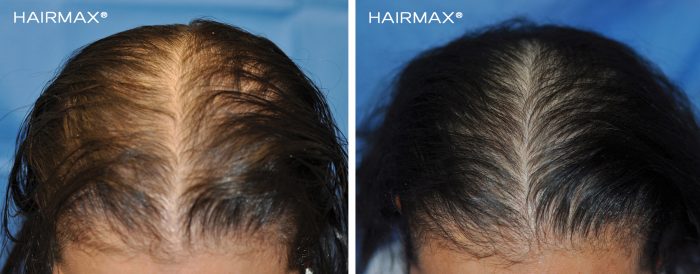 a female's head with black hair before and after using hairmax 82