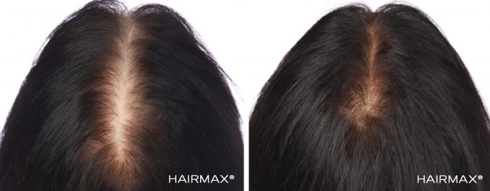 A female brunette's head before and after using hairmax 82