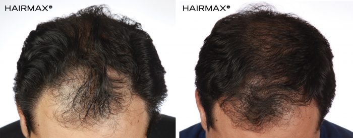 a man's head with curly hair before and after using hairmax 82