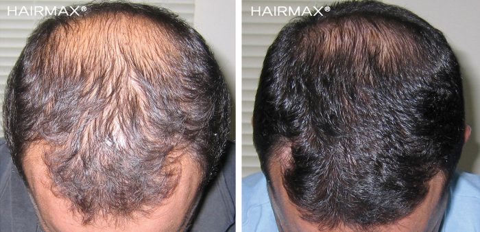 a man head with black hair before and after using hairmax 82