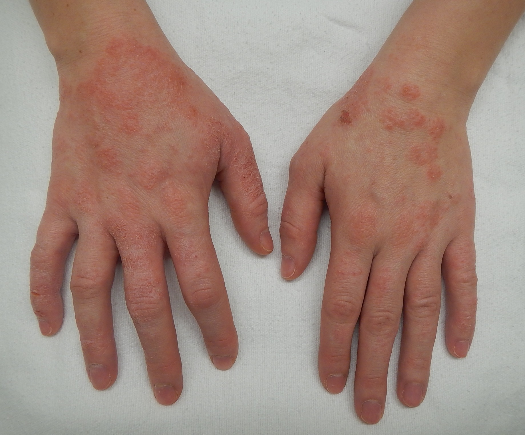 Dermatitis2015
