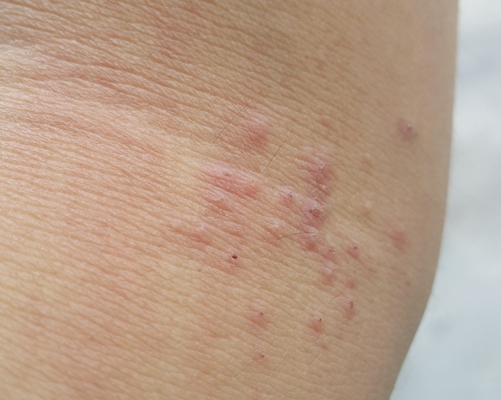[Heat Rash] shutterstock_419099419