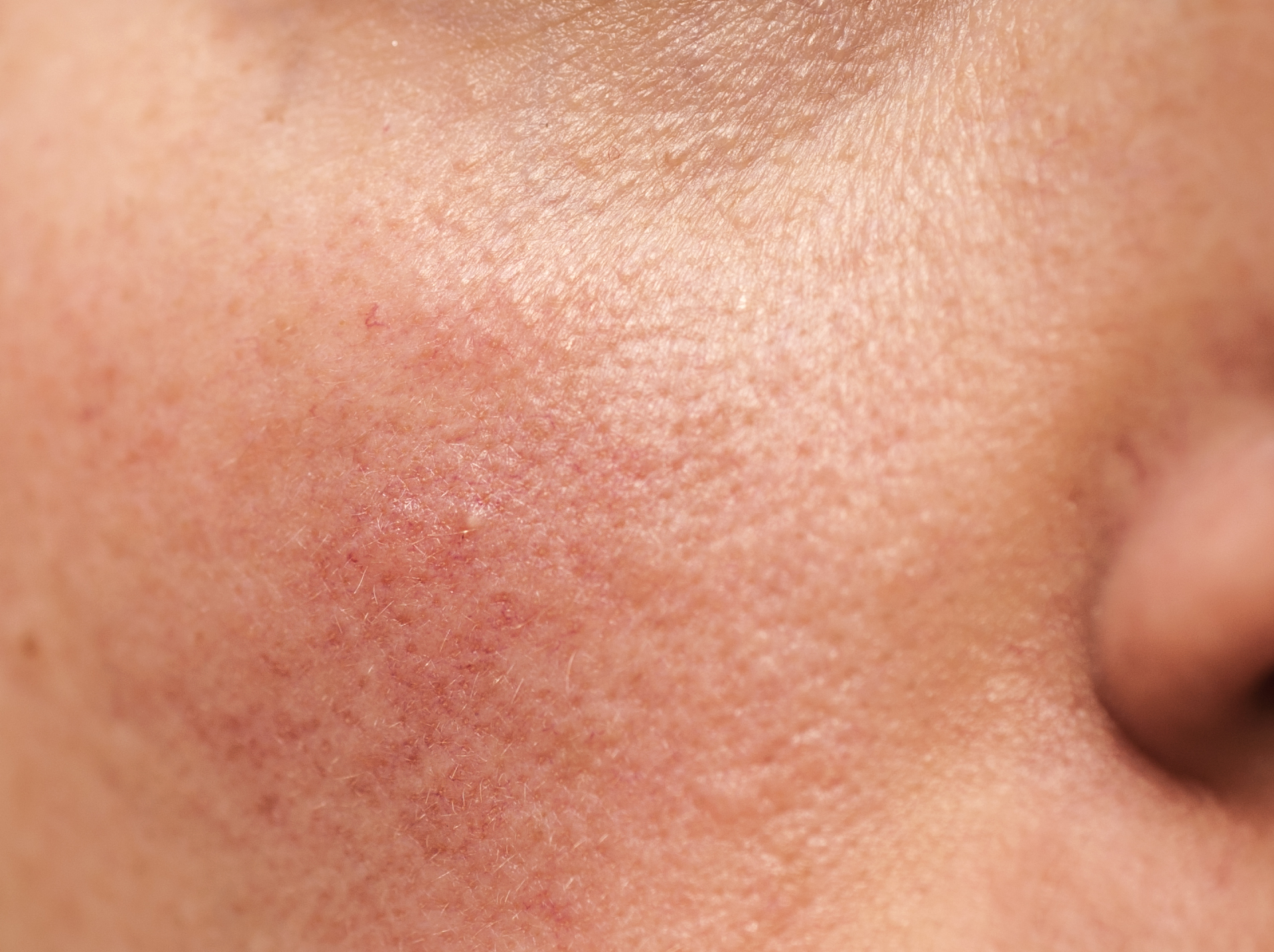 Rosacea on human skin, closeup
