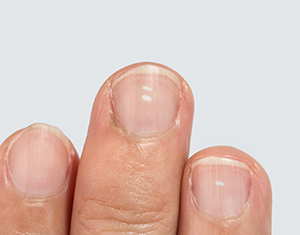 white spot on nail