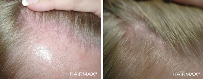 A blonde female's head before and after using hairmax 82