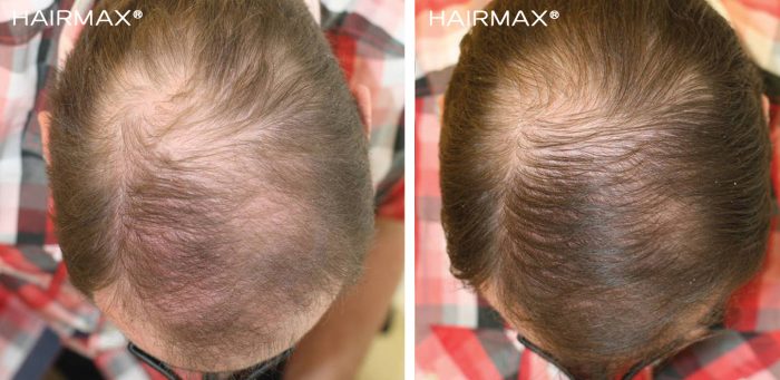 a brunette man's head before and after using hairmax 82